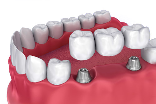 Cosmetic Dentistry bridges and crowns
