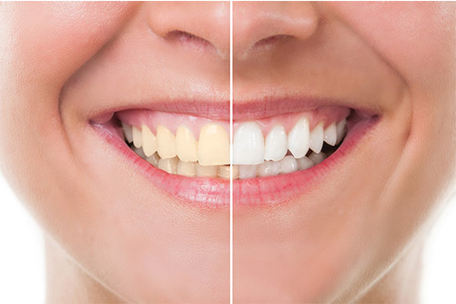 Cosmetic Dentistry Teeth Whitening