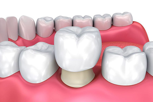 Cosmetic dentistry crowns