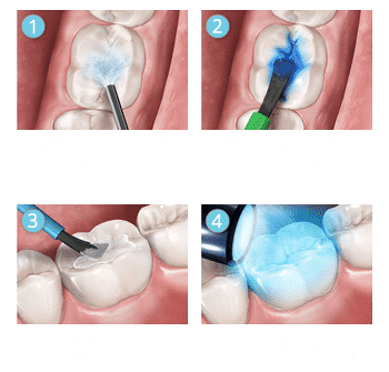 general dentistry dental sealant and application procedure