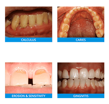 general dentistry flouride images of treatable diseases
