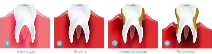 general dentistry gum disease treatment horizontal