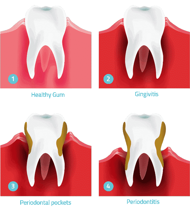 general dentistry gum disease treatment