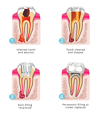 general dentistry root canal treament